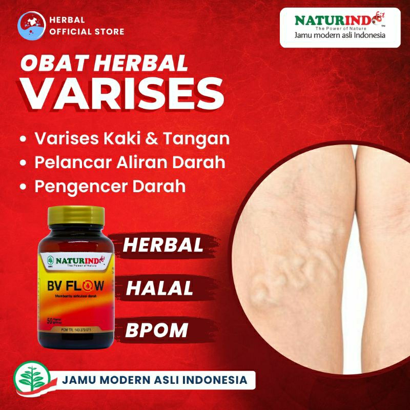 obat varises kaki dan tangan pelancar aliran darah kram otot varises kaki dan tangan