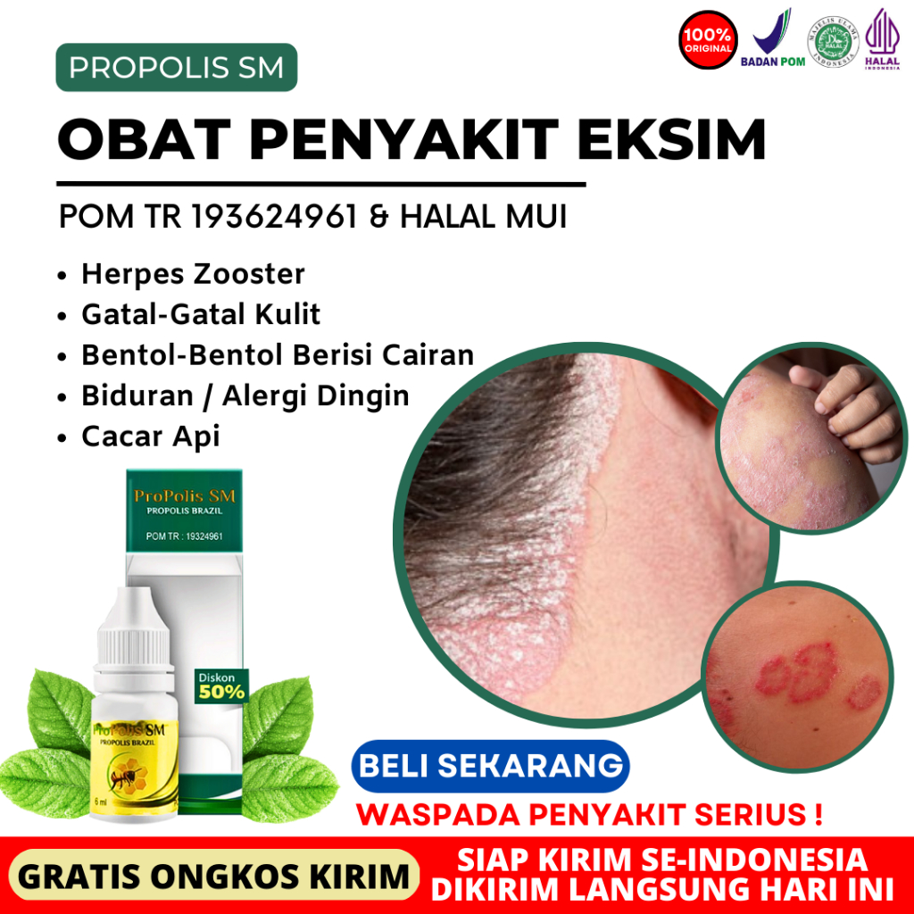 Obat Eksim Alami Tradisional - Eksim Atopik - Eksim Basah - Eksim Kering - Eximer - Eksim Bernanah