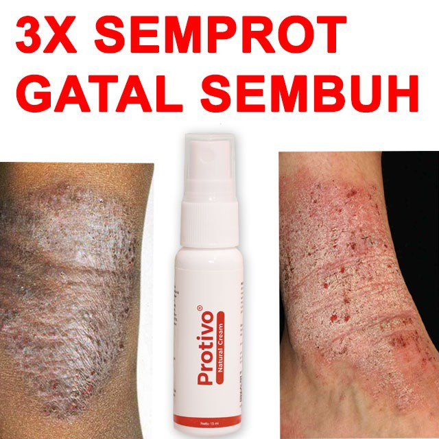 【XRAMARAHSTORE】 Orginal PROTIVO® Natural Cream Jerawat Gatal,kudis,kurap