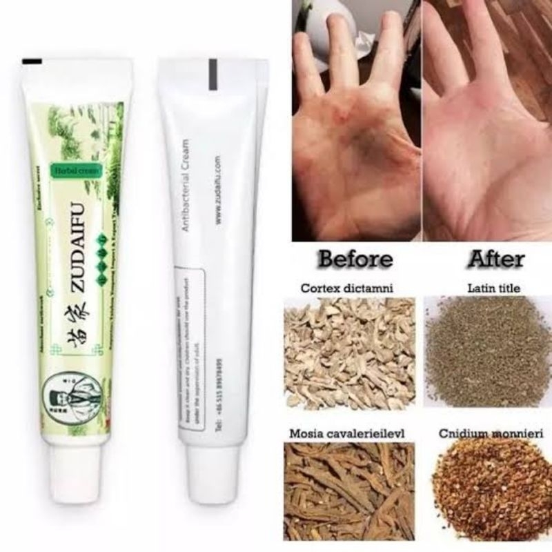 ( 100% Original ) ZUDAIFU Salep Obat Gatal Panu Kurap Eksim Kudis