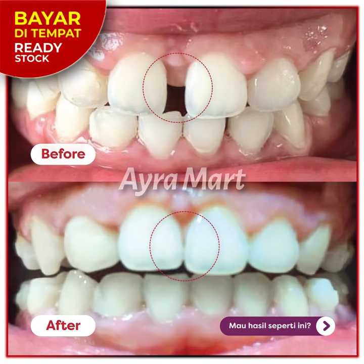 Behel perapih gigi asli dokter Alat perapih gigi yang renggang Behel perapih gigi gingsul Alat perap