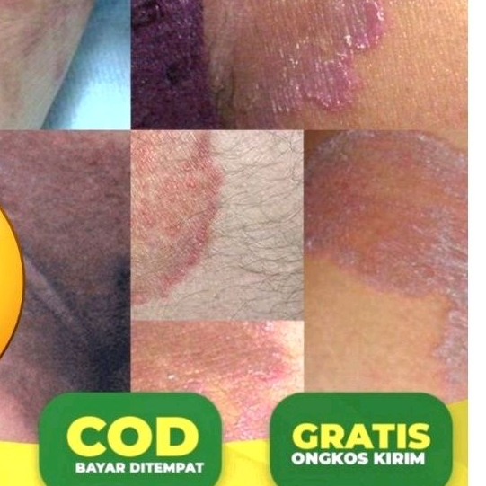 Salep Gatal Gatal Jamur / Salep Selangkangan Menahun Ampuh