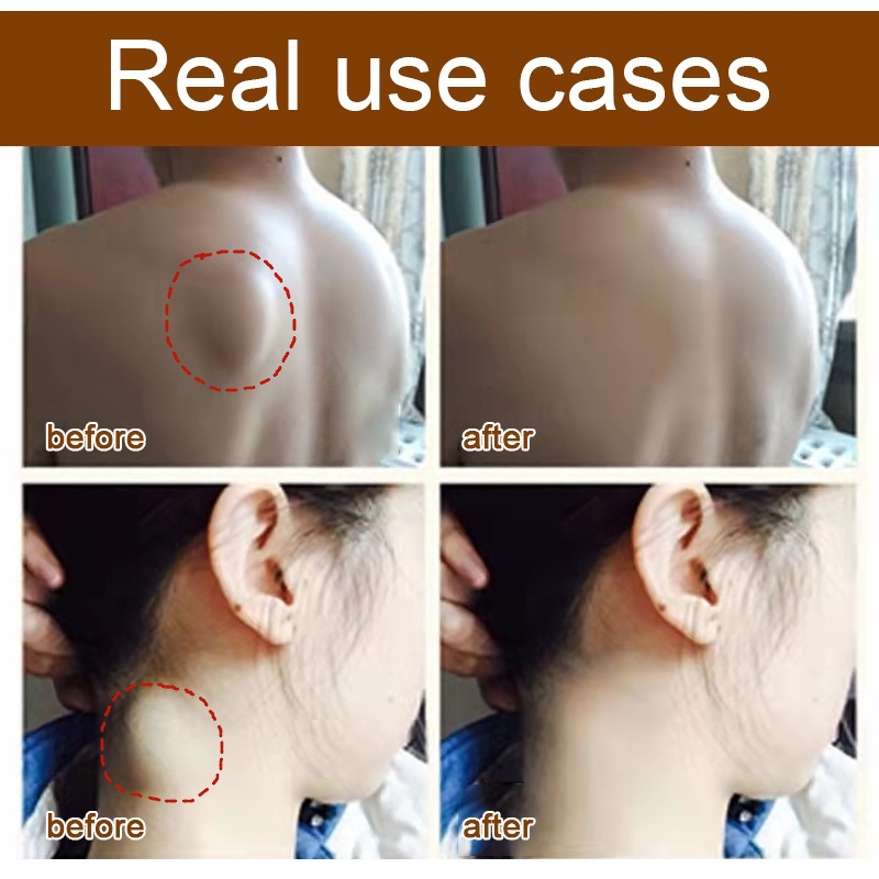【COD ORI】Lipoma Cream Original / Obat Benjolan Di Ketiak / Obat Lipoma / Salep Penghilang Benjolan / Salep Benjolan Di Leher / Salep Lipoma Paling Ampuh / Lipoma Removal Cream 20g