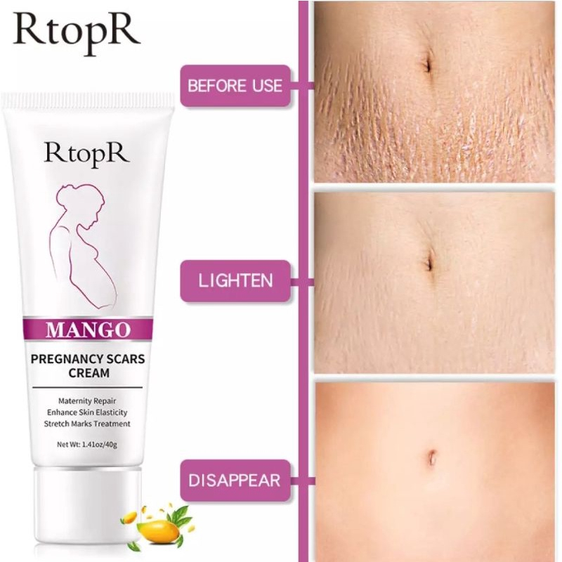 RtopR Mango Remove Pregnancy Scars Acne Cream Stretch Marks Treatment Maternity Repair Anti-Aging Anti-Winkles Firming Body Creams
