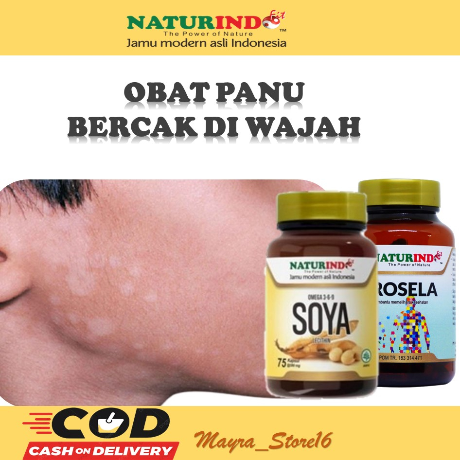 OBAT PANU DI WAJAH PANU DI PUNGGUNG BERCAK PUTIH KADAS KURAP PANU HITAM