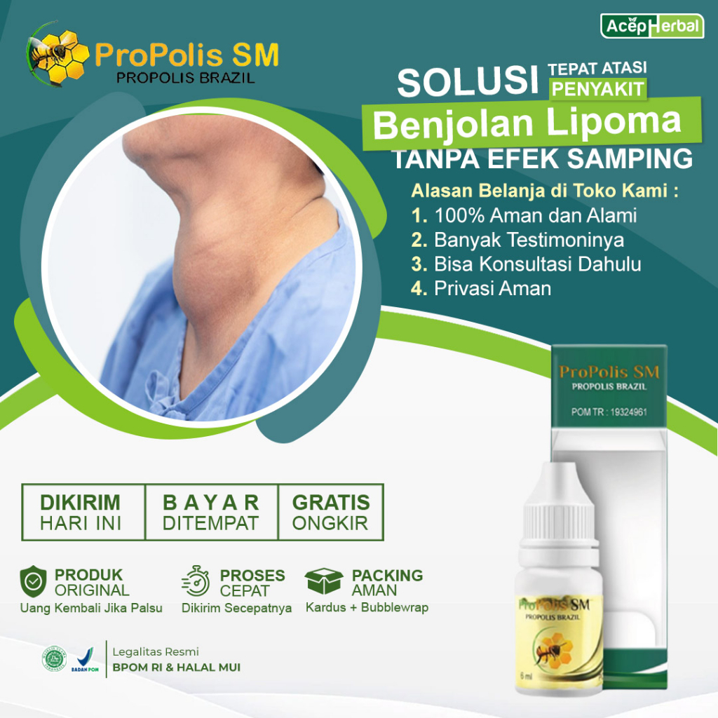 Obat Benjolan Lipoma Di Tubuh Tangan Kaki Leher Punggung Obat Pengempes Benjolan Lipoma Obat Oles Be