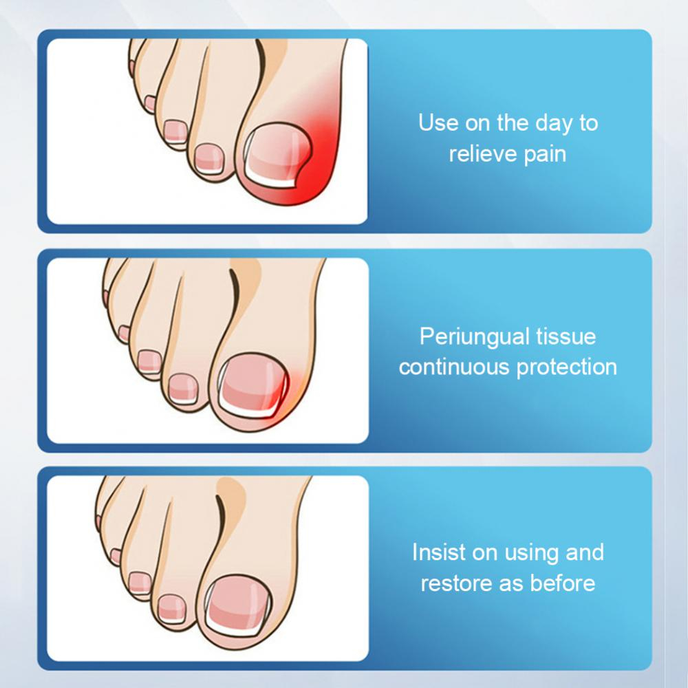 SUAI Ai Armor Guards Remove Ingrown Nail Essentl Oil Nail Groove Hair Paronychia Onychomycosis Tools