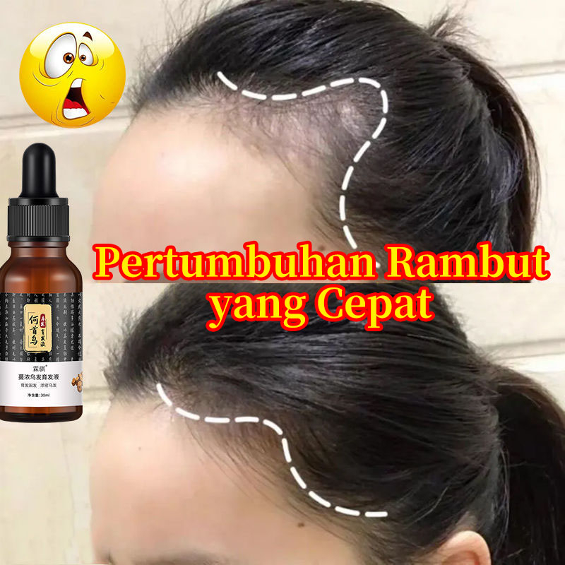 Essence Pertumbuhan Rambut Cepat, Anti-rambut Rontok Pengkondisian Anti-Rambut Rontok, Mendorong Regenerasi Rambut, Mencegah Rambut Rontok, Memelihara Perbaikan Kulit Kepala, Garis Rambut Tebal, Kondisioner Pria dan Wanita