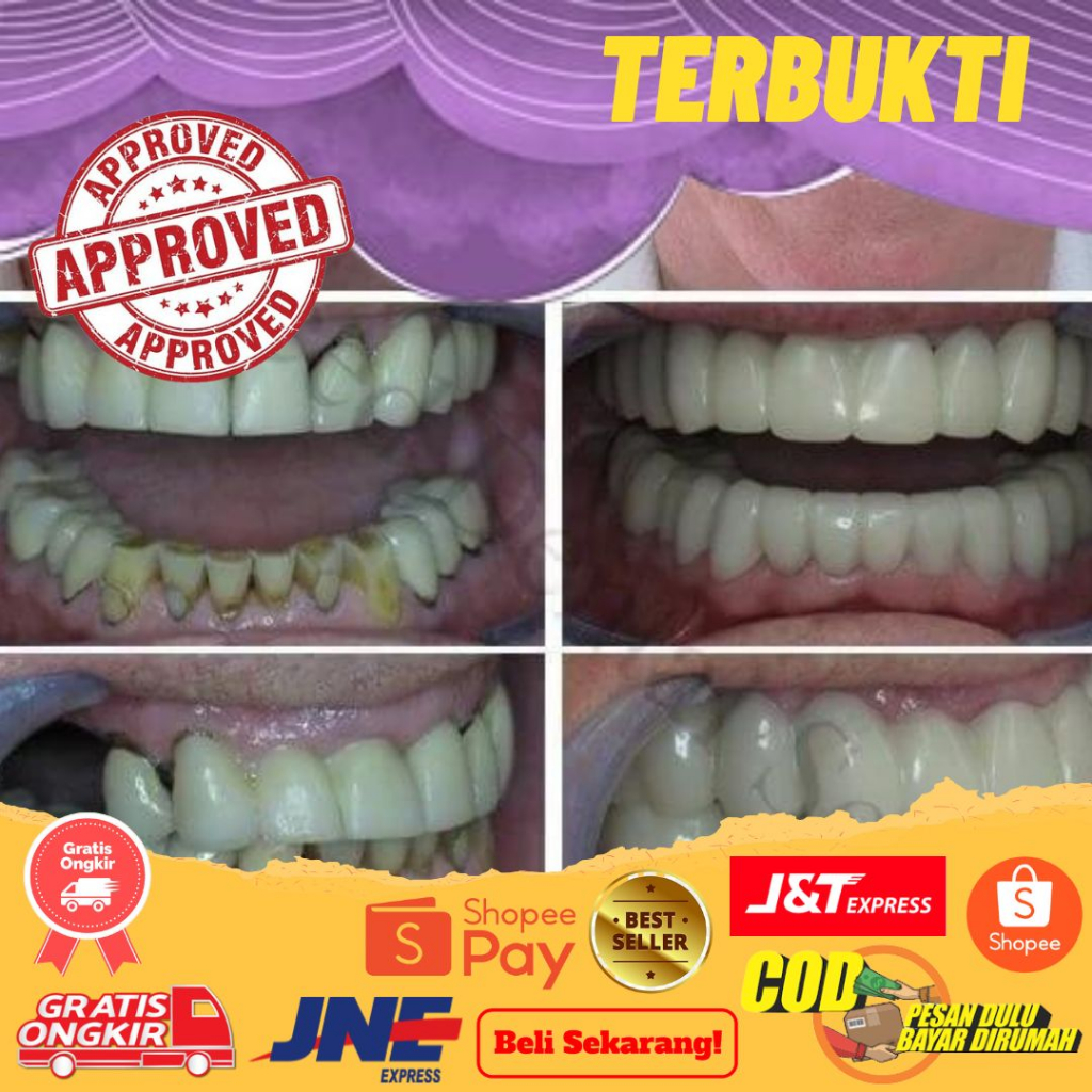 Gigi Palsu Veneer White | Not Snap On Smile | Perapih Gigi Vener White Original | Gigi Bolong | Gigi Patah | Gigi Kuning | Gigi Rusak COD Gigi Palsu Snap On Smile Venner White Gigi Palsu Terlaris