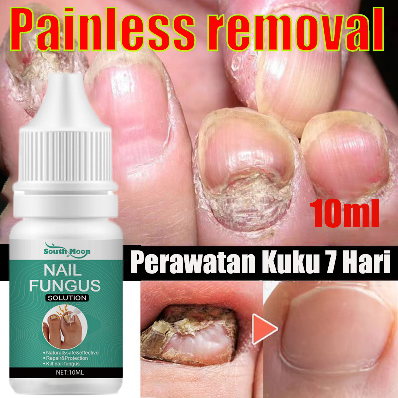 Nail Repair Essence Serum obat jamur kuku Perawatan Kuku Jamur Pemutih Kuku Penghilang Jamur Vitamin