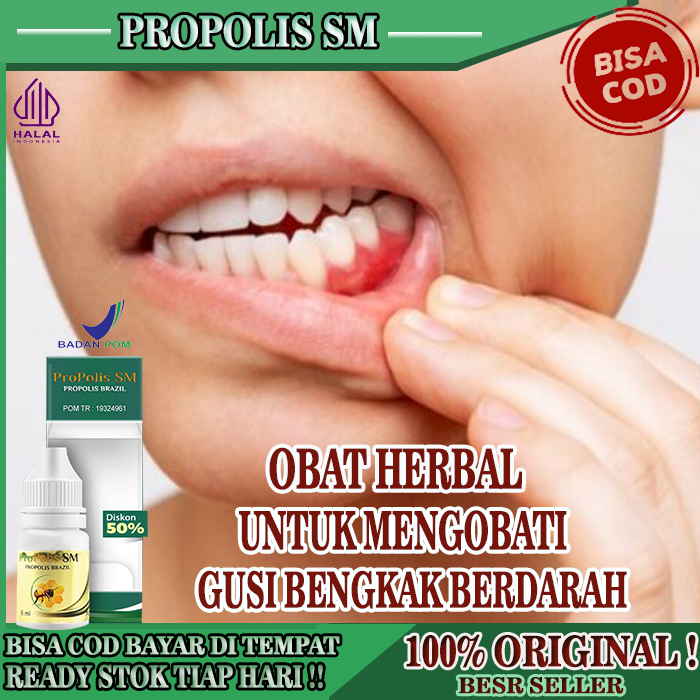 Obat Gusi Bengkak Berdarah, Gusi Bernanah, Sariawan, PROPOLIS SM ASLI, Obat Gusi Bengkak Dan Nyeri, 