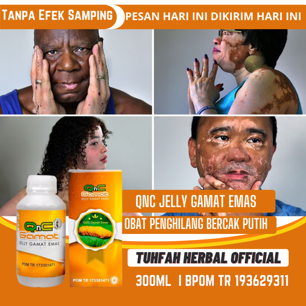 Obat Vitiligo, Obat Penghilang Vitiligo, Obat Penghilang Bercak Putih, Obat Vitiligo di Wajah dan Le