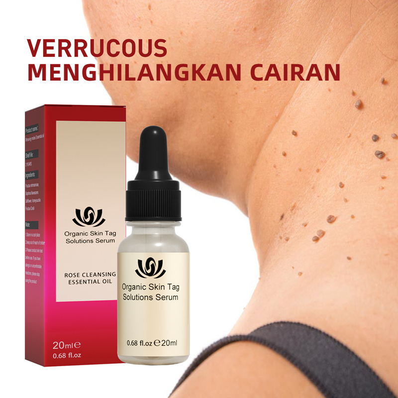 Wart Removal Cream Repair And Clean Skin Tag Papilloma Remover 20g - Menghilangkan Kutil Tahi Lalat Mata Ikan Menghilangkan Kutil Tahi Lalat Mata Ikan Wart Remover - Salep Obat Penghilang Tahi Lalat dan Kutil