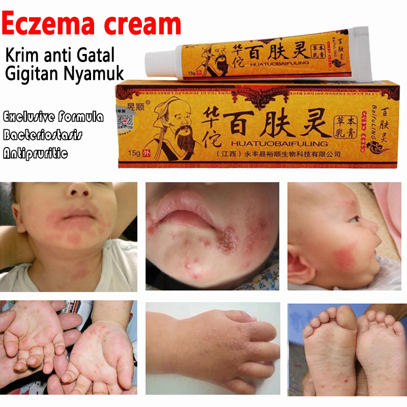 Salep Original Psoriasis Eksim Jamur Kurap Alergi Kulit Cream Cina Obat Gatal bayi Anak-Anak balita 