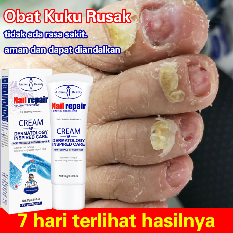 Obat Jamur Kuku Obat Kuku Penghilang Jamur Pakaian Obat Kuku Jamur Dan Rusak Perawatan Kuku Obat Jam