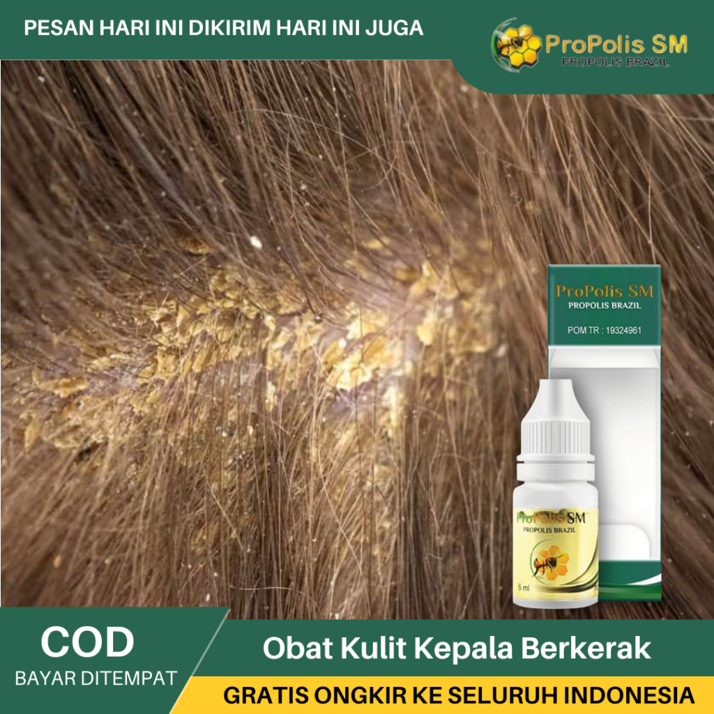 Obat Kulit Kepala Berkerak, Obat Jamur Di Kepala, Obat Kulit Kepala Bersisik, Obat Tinea Capitis, Ob