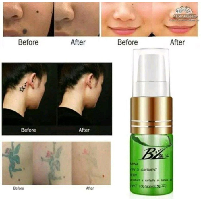 Movaro Tato Remover Penghilang Tato YM
