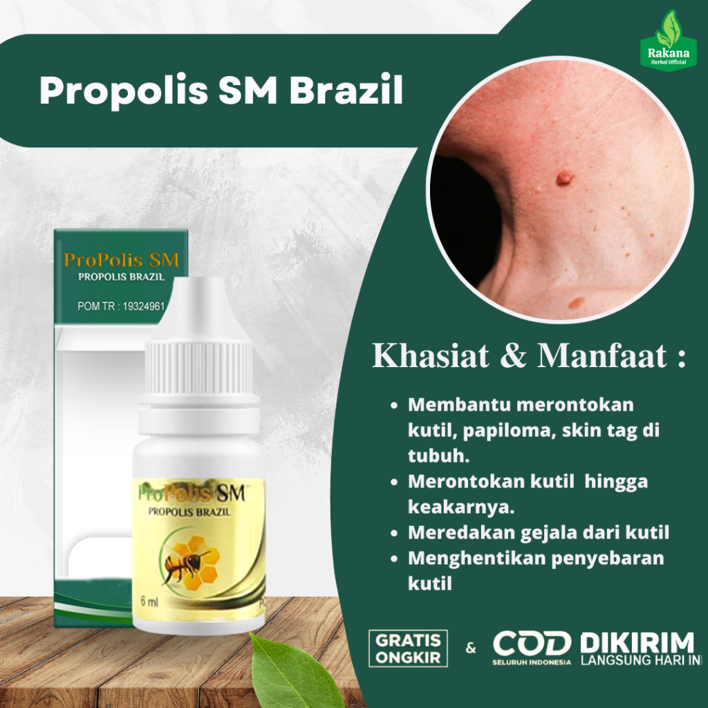 Obat Kutil Di Leher, Obat Kutil Di Wajah, Obat Kutil Di Kelopak Mata - Propolis SM