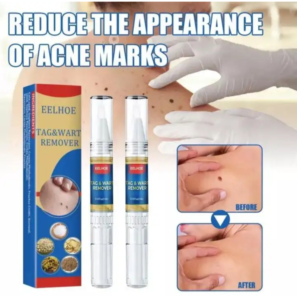 ORI EELHOE  Wart Remover Pen Krim Penghilang Lalat, Krim Penghilang Kutil, Wart Remover Cream, Mudah