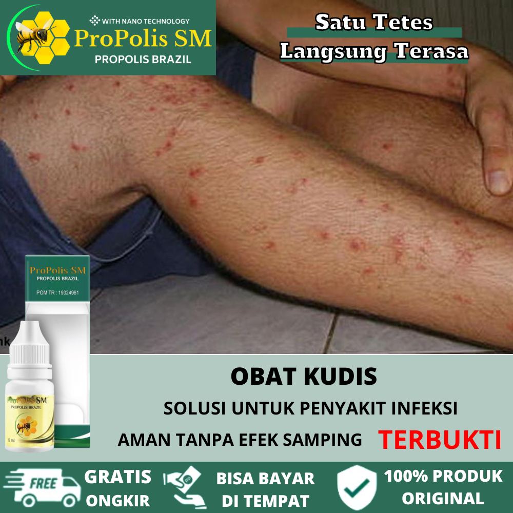 Obat Kudis, Obat Kulit Gatal, Obat Oles Kudis Gatal Dan Sakit, Pembasmi Jamur Kulit, Gatal Selangkan