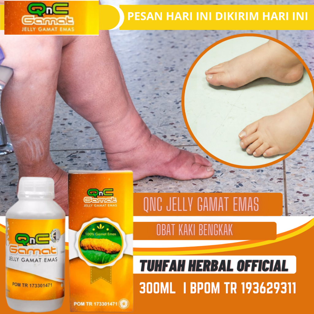 Obat Kaki Bengkak, Kaki Bengkak dan Nyeri, Kaki Bengkak Ibu Hamil, Kaki Bengkak Karena Jatuh, Kaki G