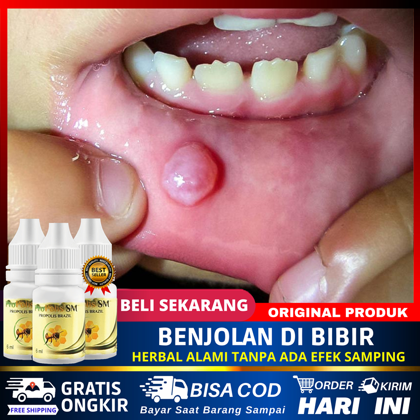 Obat Mucocele Benjolan Di Bibir Mulut Anak Dan Dewasa Salep Penghilang Benjolan Kelenjar Air Liur Lu