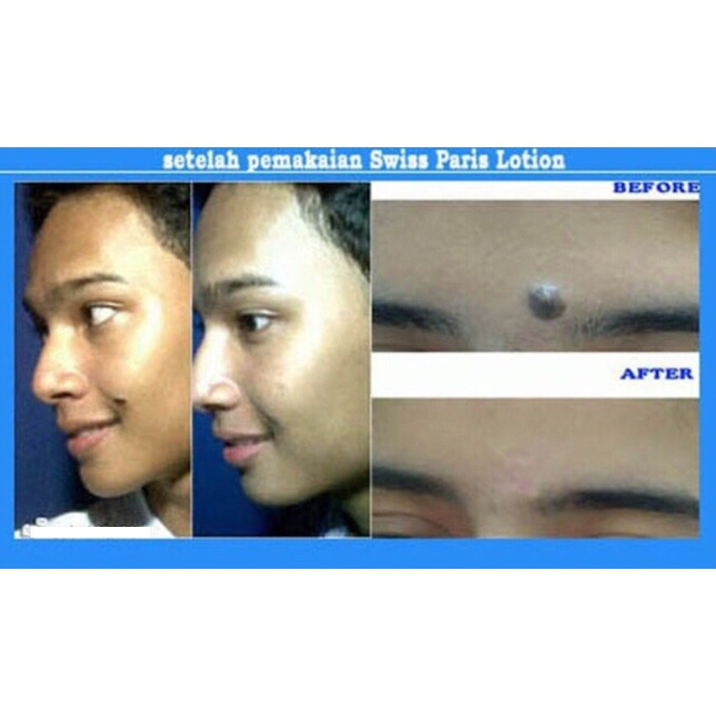 Obat Kutil / Penghilang Kutil / Penghilang Tahi Lalat / Swiss Paris Lotion