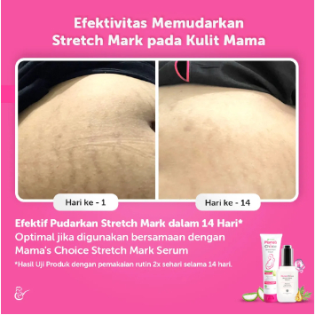 Mama's Choice Stretch Mark Cream Krim Mamas Choice 100 ml Menyamarkan Selulit Ibu Hamil Garis Perut