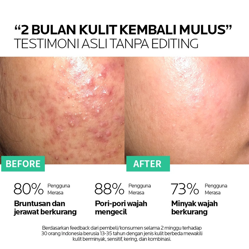 Zhenxiu Krim Anti Jerawat Krim Jerawat Salep Jerawat Cream Jerawat 20g Gel Anti Jerawat Herbal Essence Menghilangkan Jerawat Memperbaiki Kulit Dengan Cepat Menghilangkan Jerawat Pria Dan Wanita