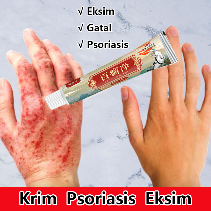 Obat Salep Gatal Salep Eksim Kering Paling Ampuh 20g Psoriasis Paling Ampuh Salep Kulit Gatal Dermatitis Jamur Anti Gatal Cream Bantuan Gatal Cepat Krim Psoriasis Eksim Original 100%