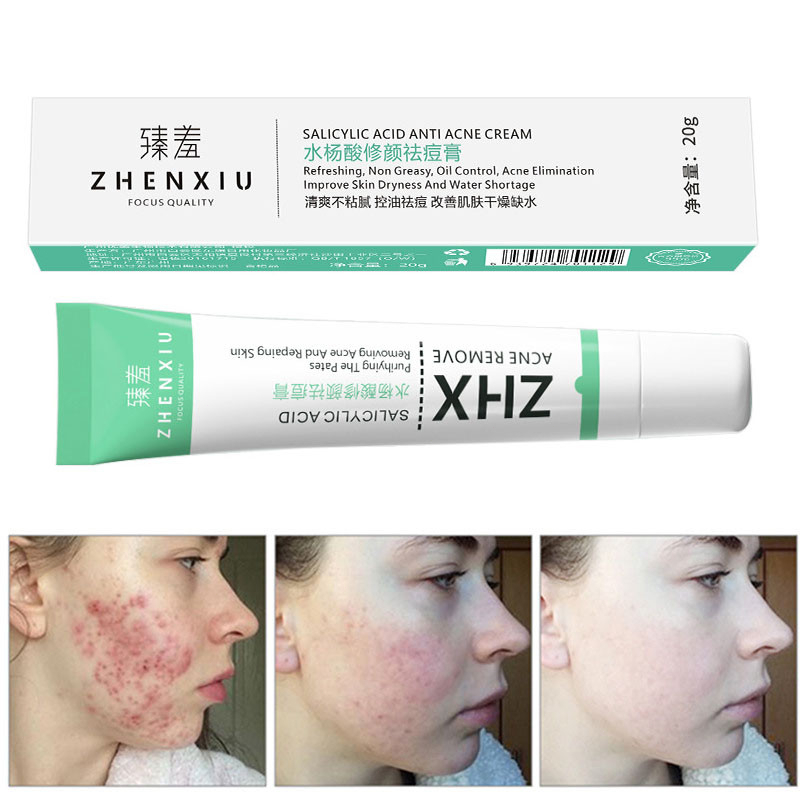 ZHENXIU Krim Anti jerawat dan Memudarkan bekas jerawat Cepat Salep Jerawat 20g Original Anti acne Herbal Essence Menghilangkan Jerawat Memperbaiki Kulit Pria dan Wanita