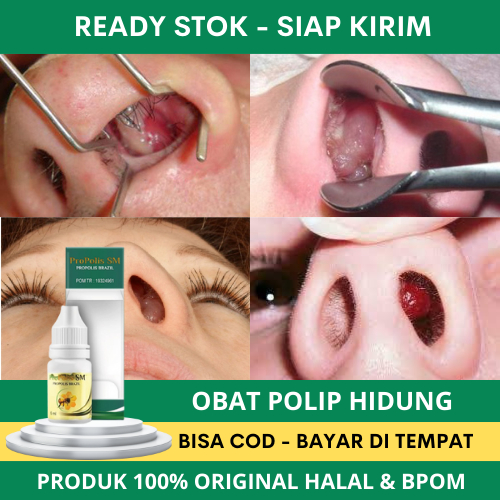 Obat Tetes Polip Hidung, Obat Polip Hidung Kronis Dan Akut, Hidung Mampet, Hidung Tersumbat, Polip A