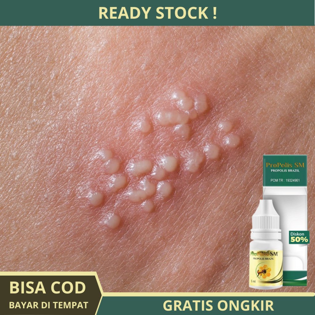 Obat Herpes Kelamin, Obat Penis Herpes, Obat Herpes Genital, Obat Penis Gatal, Obat Herpes Zoster, O