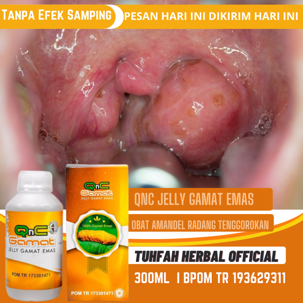 Obat Amandel, Radang Tenggorokan, Sakit Tenggorokan, Asam Lambung, Maag, Diabetes, Ambeien, Darah Ti