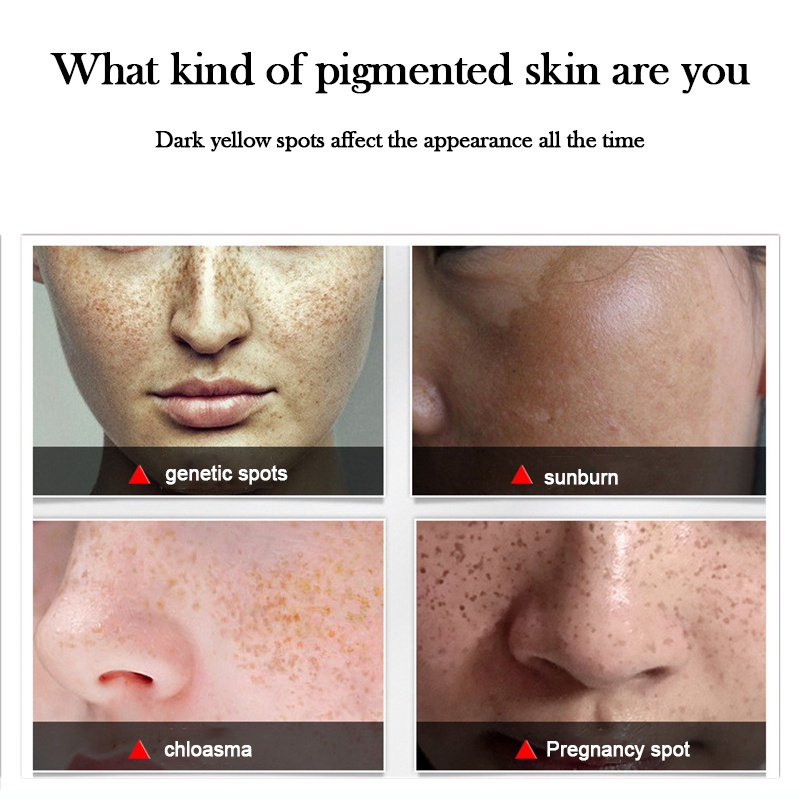 SK FI DIOR - SK Whitening Freckle Cream Remove Dark Spots Anti Freckle Cream Niacinamide Fade Pigmentation Melasma Brighten Creams 【 Free Delivery+ COD + dikirim dalam 24 jam】