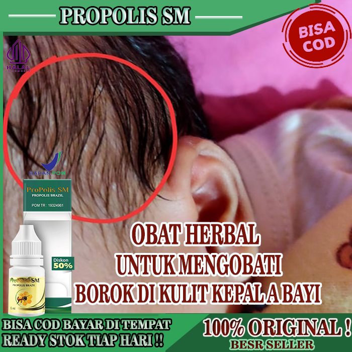 Obat Untuk Borok Di Kepala Anak, Obat Untuk Korengan/Borok Di Kulit Kepala Anak, Propolis Sm Obat In