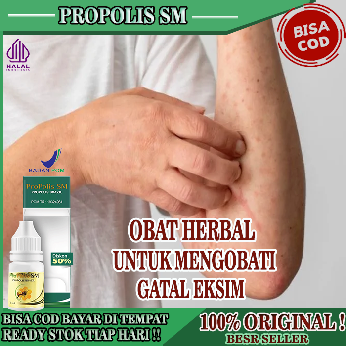 Obat Kulit Gatal Eksim,  Penghilang Eksim Kering Alami Dengan Propolis Sm Brazilian, Obat Eksim Keri