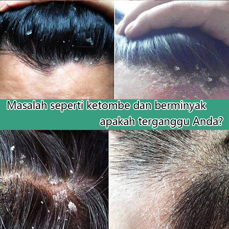 Anti-dandruff shampoo Sampo anti ketombe Shampo anti rontok Pengontrol minyak, anti-gatal, anti-ketombe, anti-penumpahan Bahan garam laut impor, penghilangan tungau 99%.Shampo anti ketombe dan anti gatal paling ampuh di Indonesia