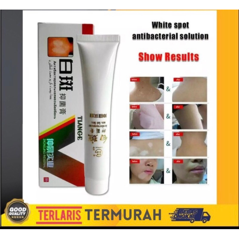 Tiange obat salep penyakit kulit vitiligo - bercak putih kulit belang