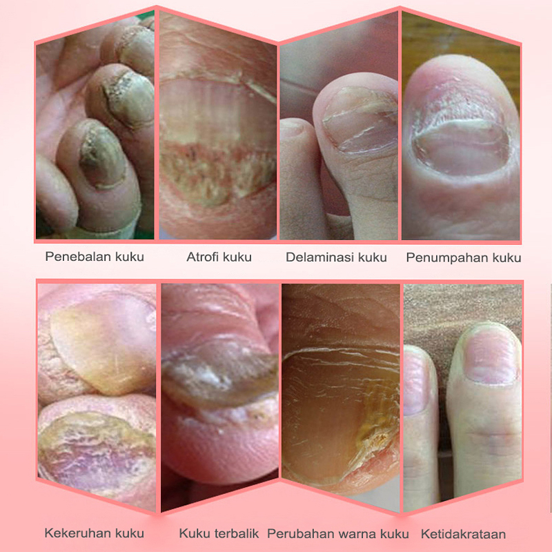 Perawatan Jamur Kuku  Obat kuku jamur dan rusak  Onikomikosis Paronychia Perbaikan Kuku Cair 25ml Ringan dan tidak mengiritasi