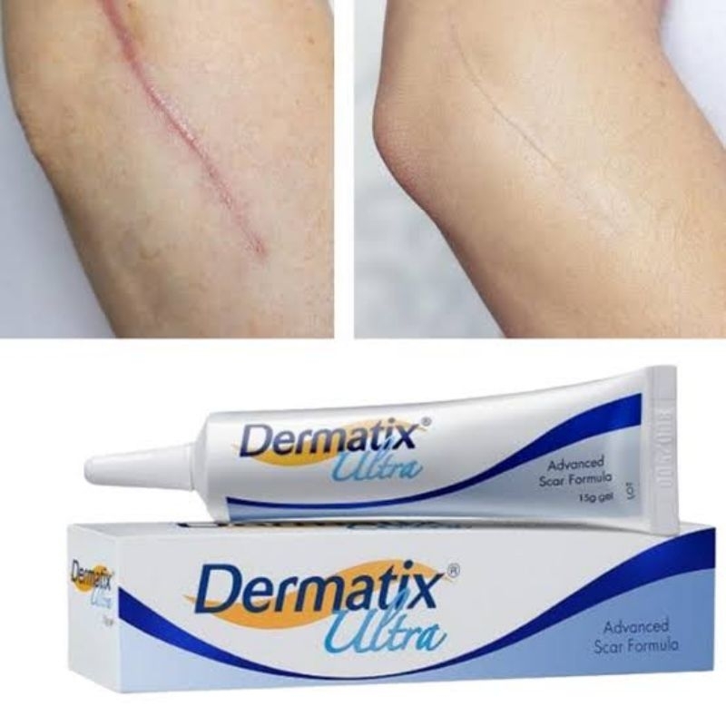 READY DERMATIX ULTRA Advance Scar Formula 15gr ORI
