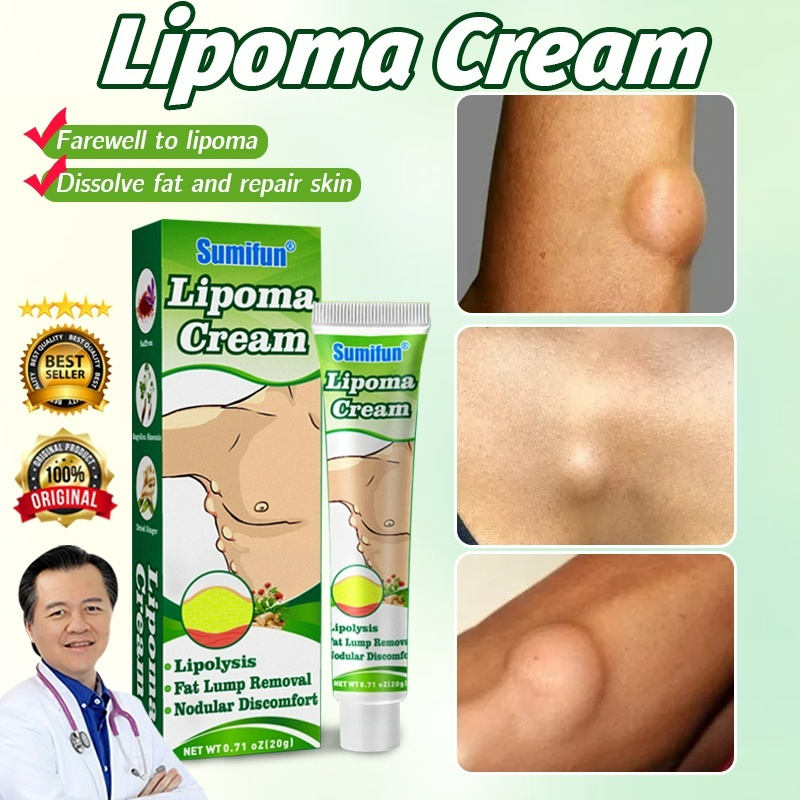 Lipoma Cream Salep Lipoma Salep Benjolan 20g Obat Lipoma Obat Benjolan Penghilang Benjolan Penghancur Benjolan Pengempis