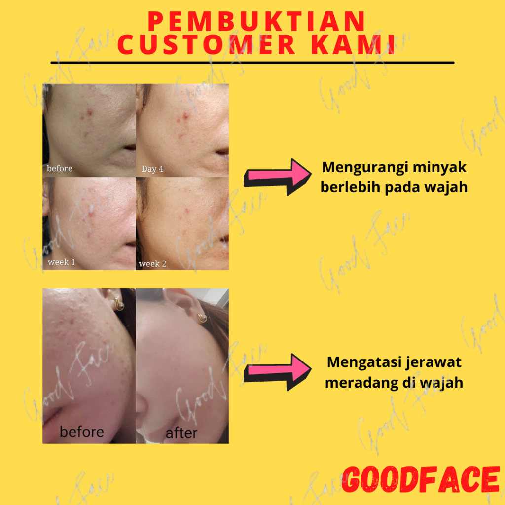 BREYLEE Acne Cleanser Set E - Membersihkan Wajah Berjerawat 2 pcs