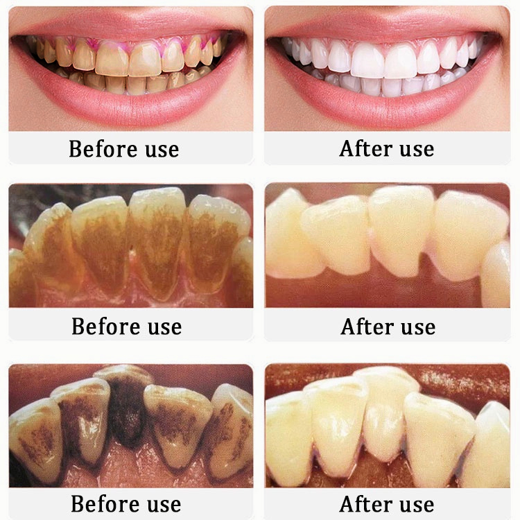 Pasta Gigi Pemutih Permanen Penghilang Karang Gigi dan Gigi Kuning 290g Press-Type Berkapasitas Besar Pasta Gigi Probiotik Menyeimbangkan Bakteri Mulut Teeth Whitening Toothpaste