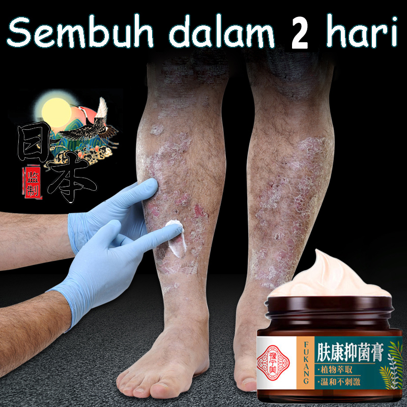 Salep gatal paling ampuh obat gatal salep gatel salep cina salap gatal salep obat gatal gatal Diimpor dari China Formula herbal China Penjualan Panas TIKTOK Sangat Direkomendasikan