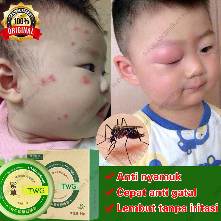 [100% Asli ] Salep gatal Obat gatal paling ampuh Obat gatal kulit 20g Anti gatal cepat/krim  gigitan nyamuk anti-gatal/Balsem gigitan tungau/menghilangkan pembengkakan/Bumil dan bayi dapat menggunakan