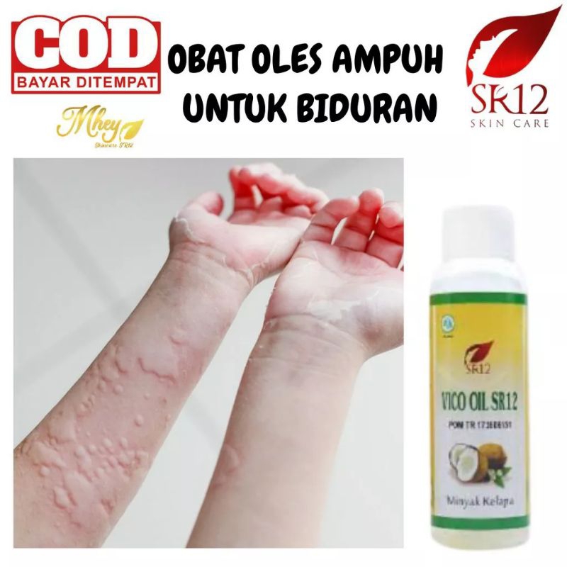 AMPUH ATASI GATAL GATAL / BIDURAN / KALIGATA / ALERGI / CACAR