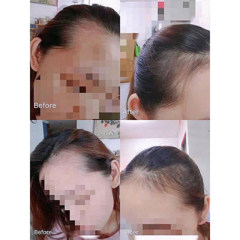 SERUM PENUMBUH RAMBUT DAN ANTI RONTOK JEPANG MENUMBUHKAN JUGA MELEBATKAN EFEKTIF DAN PASTI BERHASIL SERUM ALOPECIA SERUM SEBORRHEA