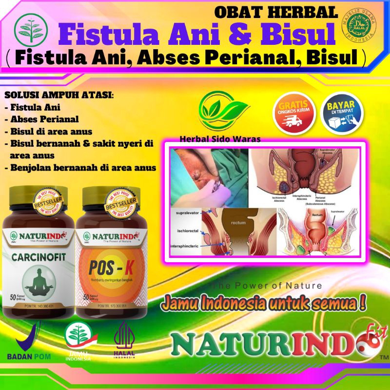Obat Fistula Ani Obat Abses Perianal Obat Bisul Ampuh Obat Bisul  Herbal Ampuh Vistula Fistula Radan