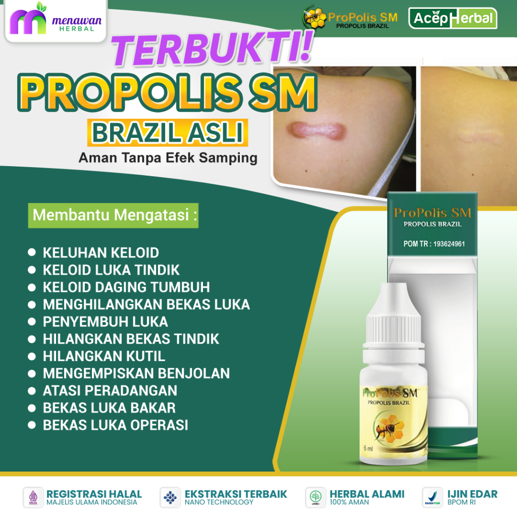 Propolis SM - Obat Keloid, Obat keloid Luka tindik, Obat keloid daging tumbuh, Penghilang keloid dag